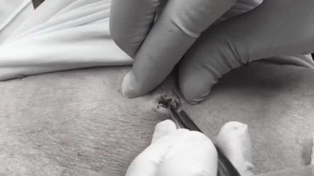 La doctora Lee saca un punto negro ENORME Dra Sandra Lee Especialista en piel Discovery HH_1080p